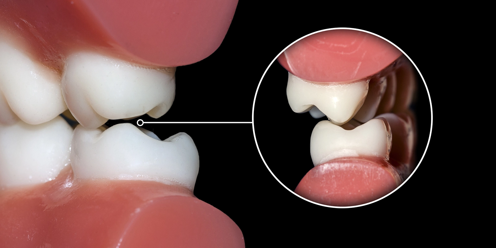 食いしばり・歯ぎしりから美容まで、ボトックス治療