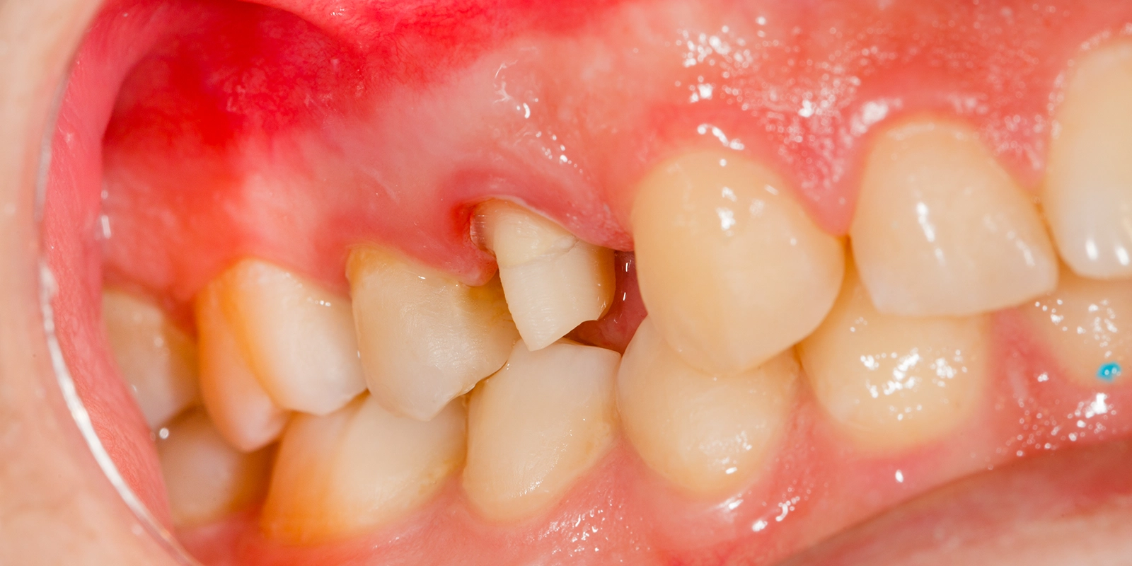 歯を失う原因の第一位、歯周病を適切に治療