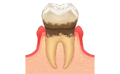 軽度歯周炎の症状と治療