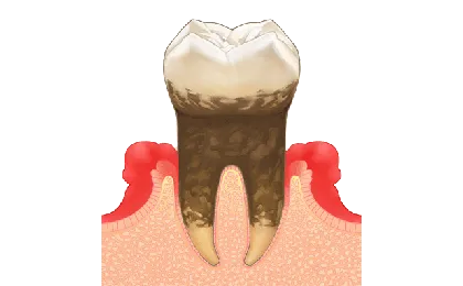 中等度歯周炎の症状と治療