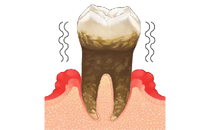 重度歯周炎の症状と治療